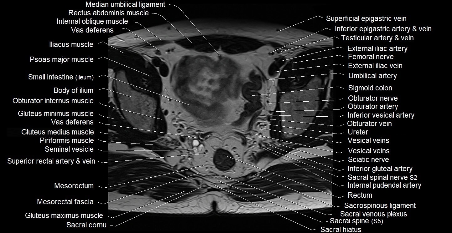 Male pelvis axial cross sectional anatomy image 20.webp